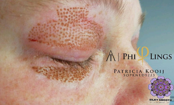 Plasmalifting ooglift